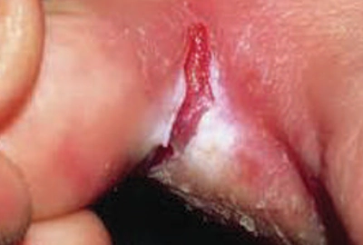 Athlete’s foot infection