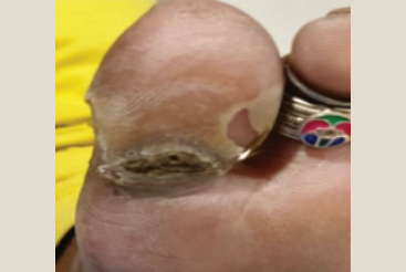 Before Callus Shaving