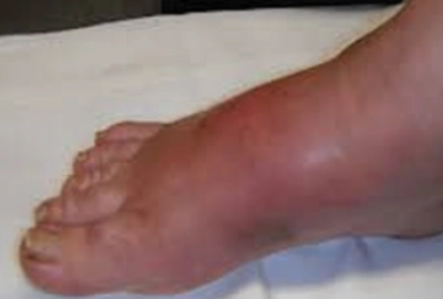 Charcot’s foot deformity