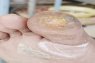 Completely healed foot ulcer