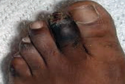 Foot gangrene condition