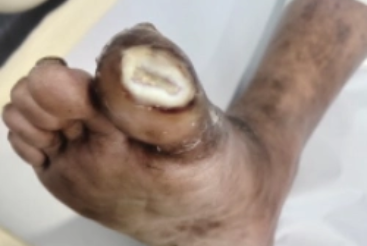 Severe PVD Neuro Ischemic Foot Ulcer