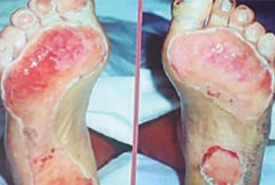 Painless Diabetic Neuropthy Symptoms