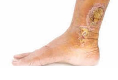 Venous ulcer on leg