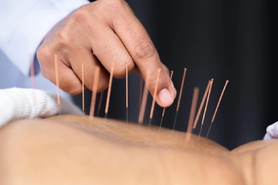 Acupunture therapy